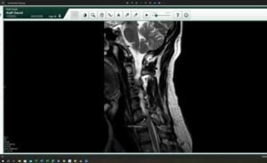 Cervical spine MRI image of Dr. Kaff showing a ruptured disc compressing the spinal cord and nerves, an example of the injuries treated at Frisco Spinal Rehab with advanced spinal decompression therapy.