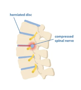 Medical illustration of a lumbar herniated disc pressing on a spinal nerve root, a common cause of sciatica and back pain, treated with DRX9000 spinal decompression at Frisco Spinal Rehab.