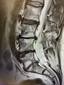 L3-L4, L4-L5, L5-S1 Disc bulges and herniations in Plano, Frisco, Little Elm, The Colony, Prosper, Celina.
