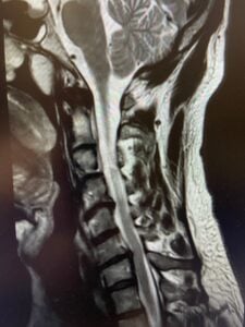 C6-C7 cervical disc herniation in the neck being evaluated for non-surgical spinal decompression using the cervical DRX at Frisco Spinal Rehab in Frisco, Texas.