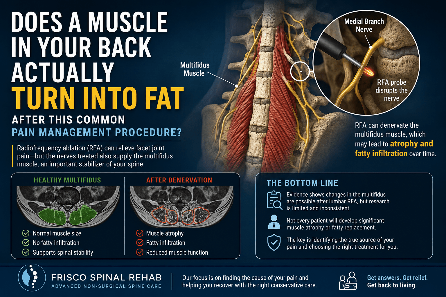 Ablation visual on multifidi turning into fat following procedure